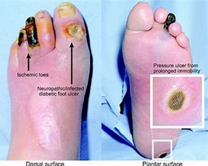 Clinical Photo of Diabetic Foot Ulcer
